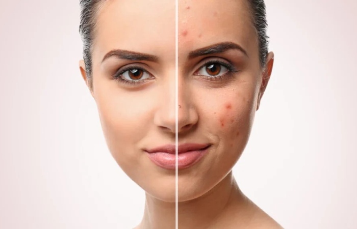 Maintaining Blemish-free Skin